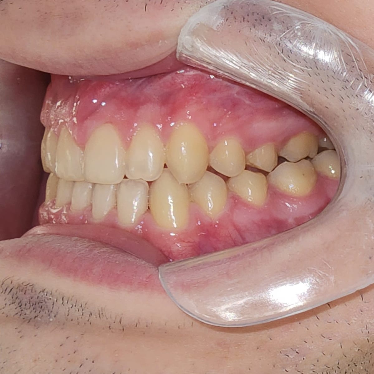 O mesmo lado da arcada em maio de 2025, sem o aparelho, com afastador labial