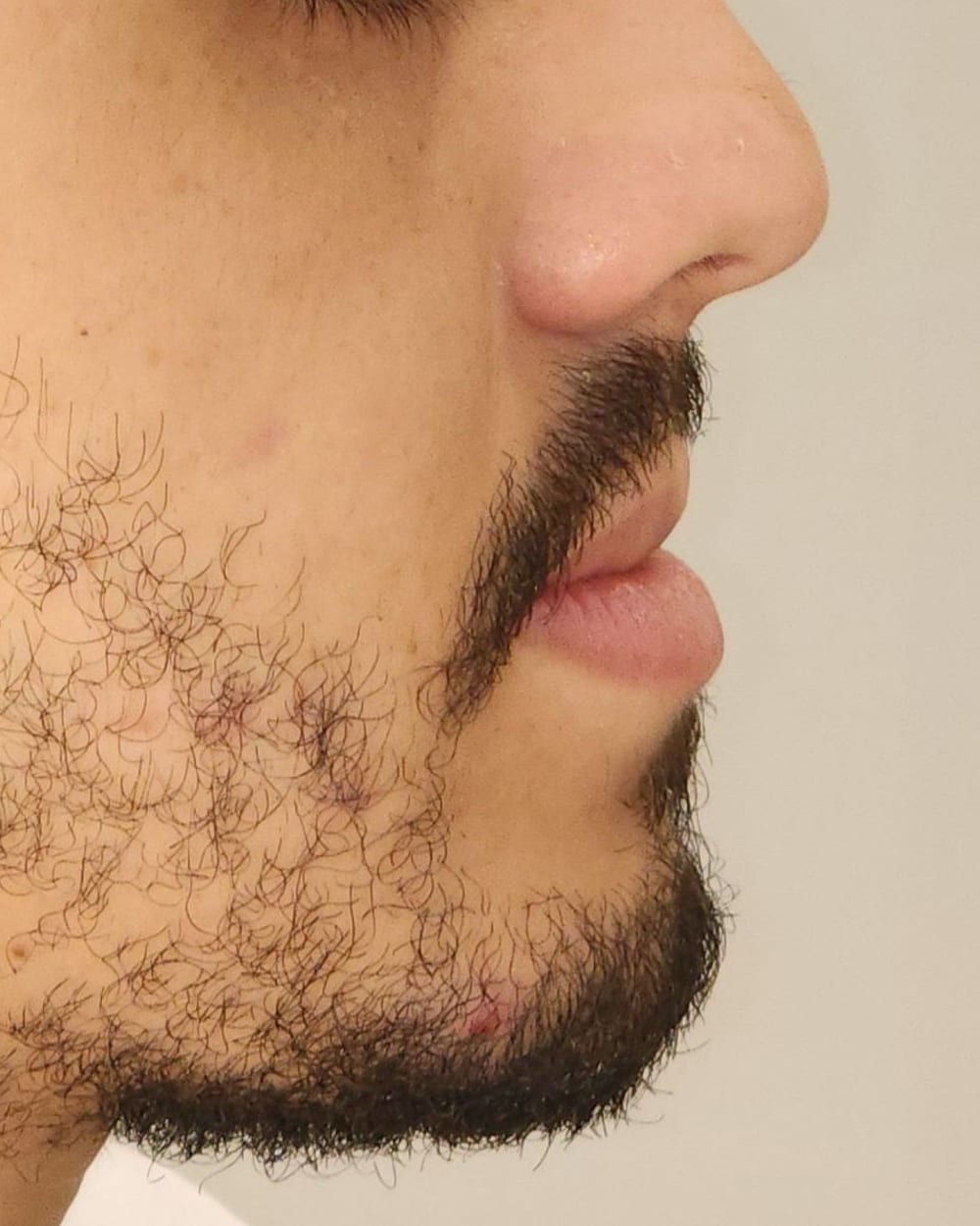 Perfil do paciente em março de 2024, em repouso, com barba e aparelho fixo