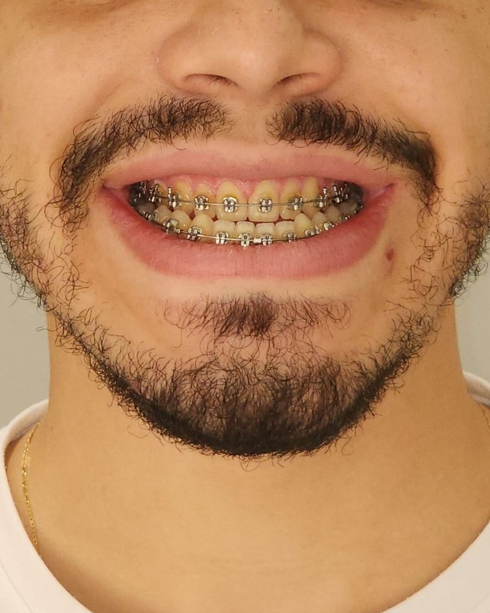 Sorriso do paciente em março de 2024, com o aparelho fixo